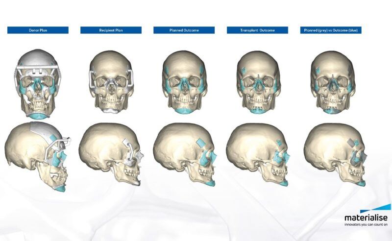 3D Technologies Support World’s First Successful Double Hand and Face Transplant - Materialise